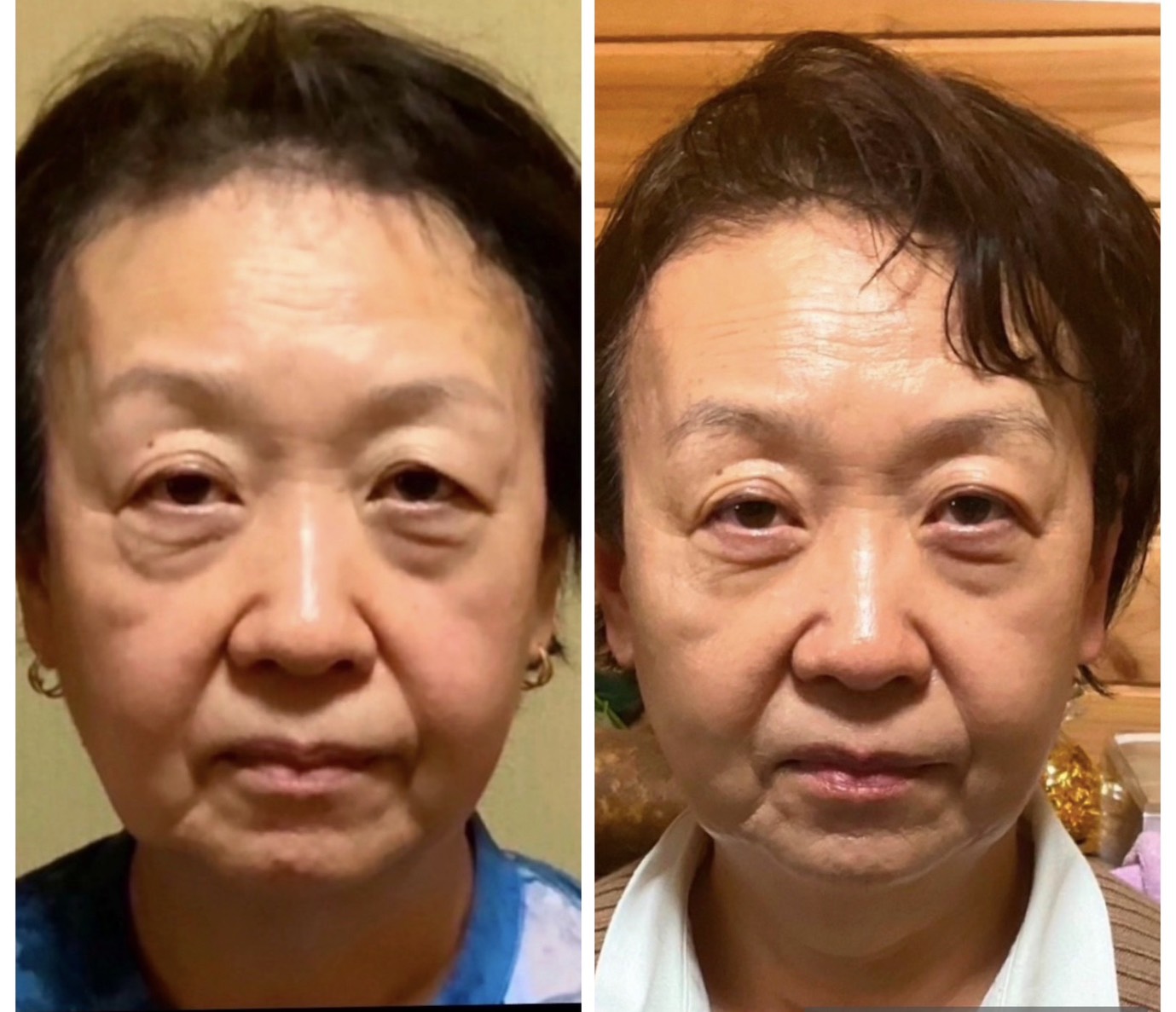 ダイヤモンドピール使用前後
