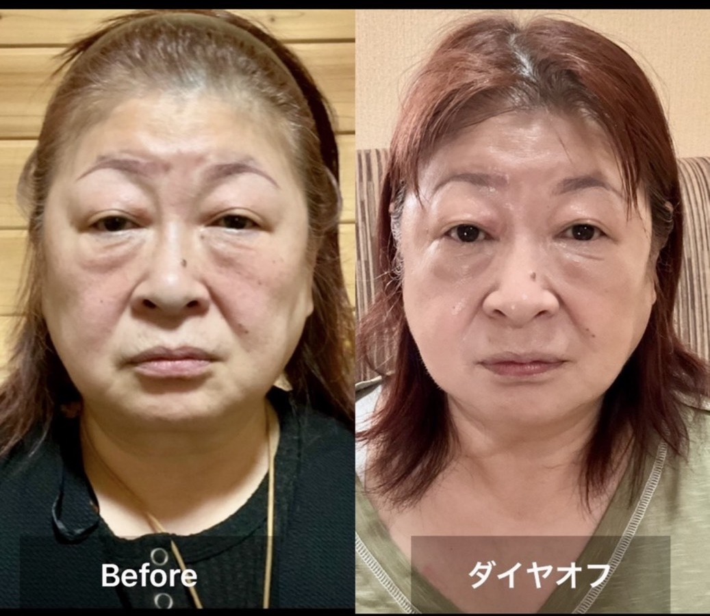 Before ダイヤオフ