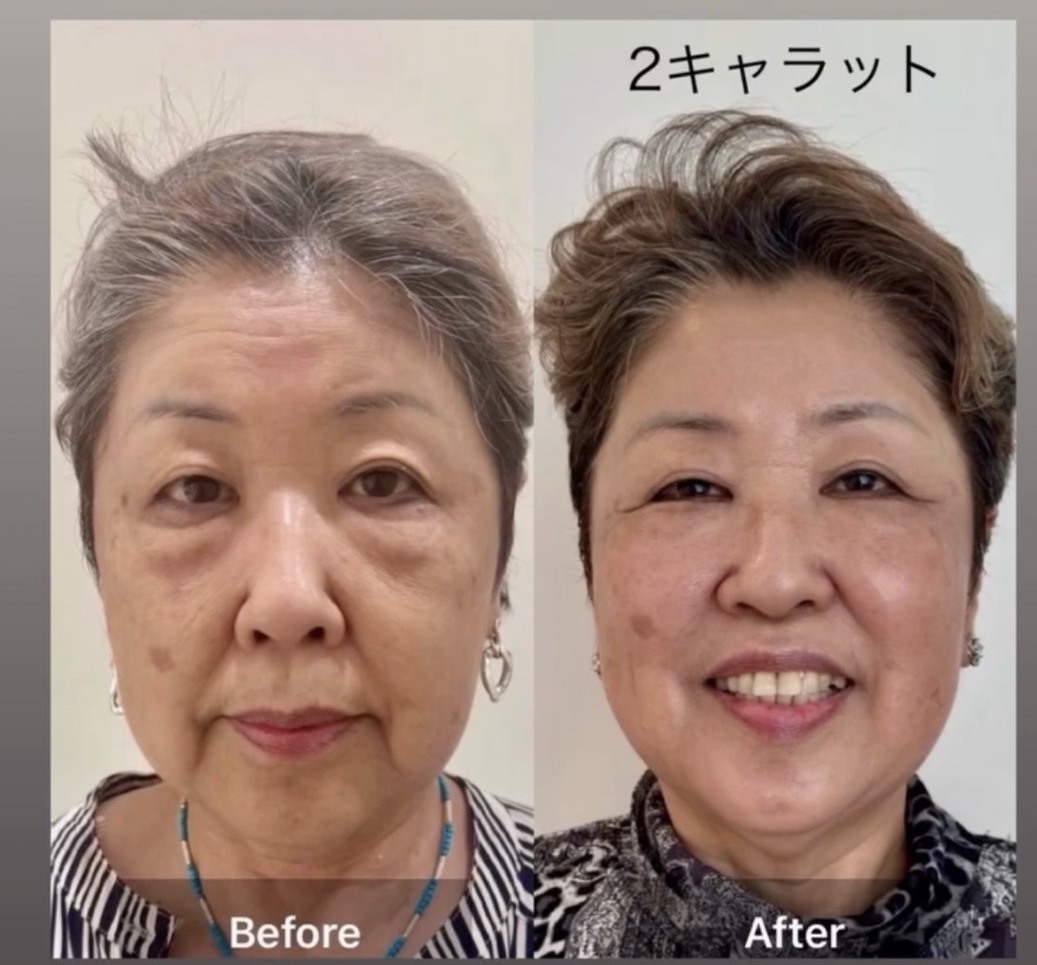 2キャラット Before After