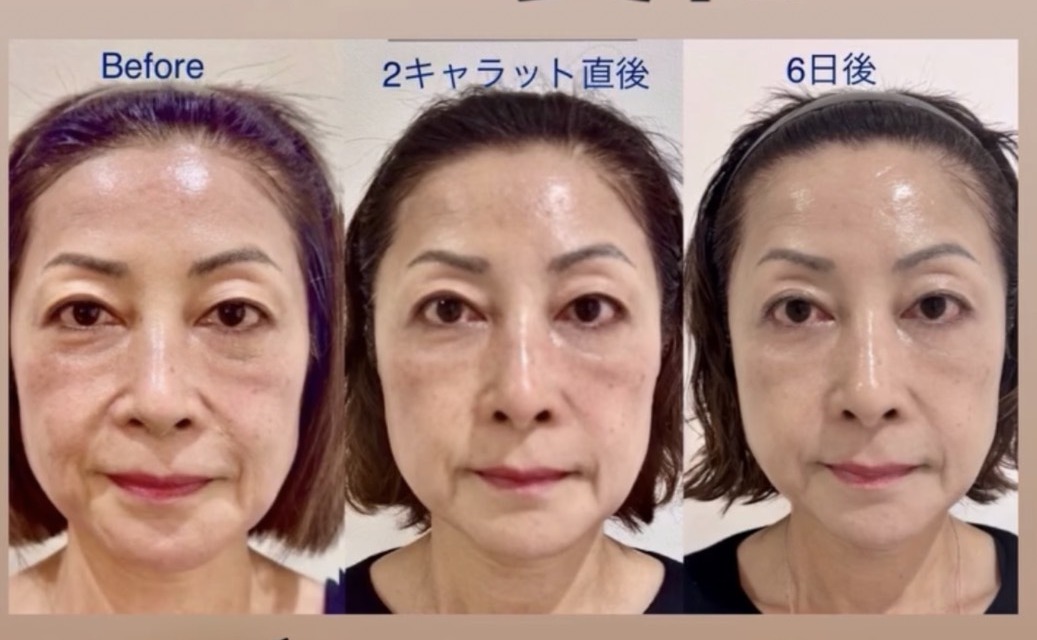Before 2キャラット直後 6日後の3段階