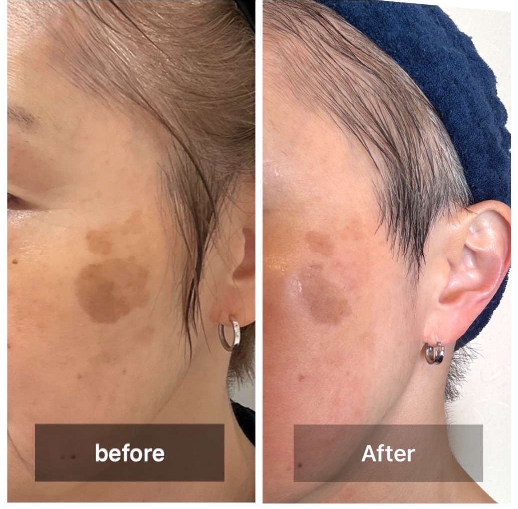 頬のくすみ Before After